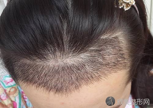 为什么植发后还掉发？在天津宁河区种植头发手术后该怎么护理？