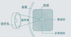 半岛超声炮怎么快速查真伪，几步教你怎么闭坑