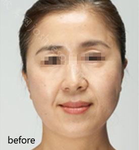 面部除皱较好的方法是什么?超声刀拉皮不同于其他拉皮之处