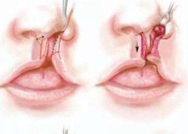 唇腭裂鼻子是什么原因造成？塌陷修复方法有哪些？