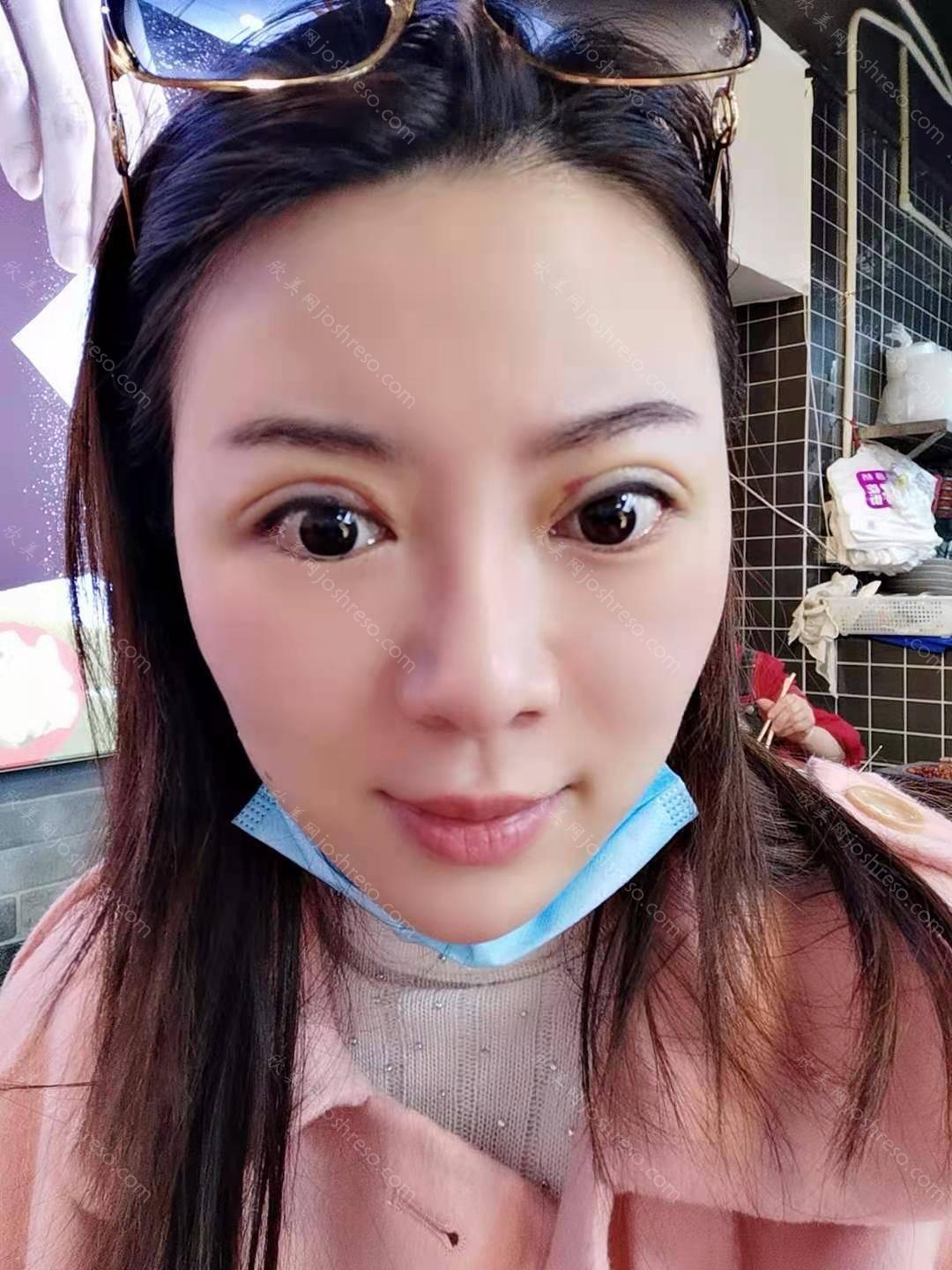 八大处于晓波割双眼皮案例！项目价格价格表2024~