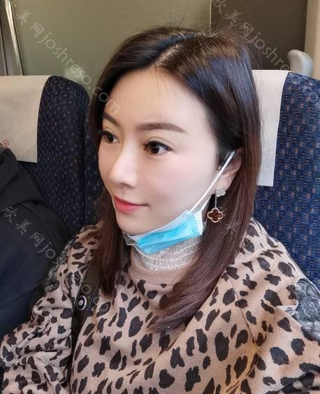 八大处于晓波割双眼皮案例！项目价格价格表2024~