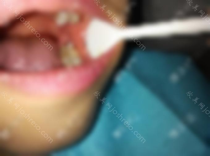 如何治疗牙髓息肉？有牙髓息肉的坏牙能直接拔掉吗？