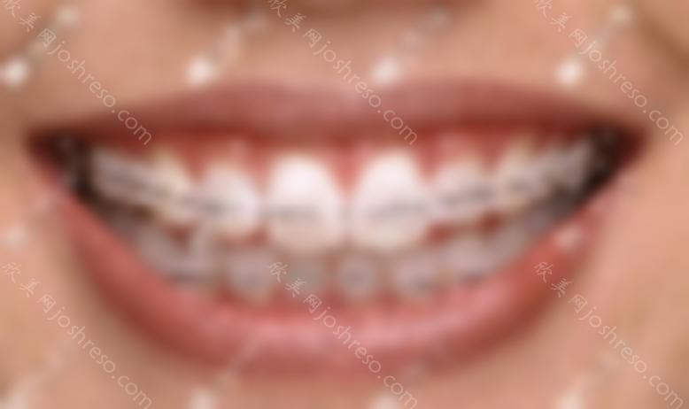 贵阳牙齿矫正价目表已安排在箍牙前必须知道的地方