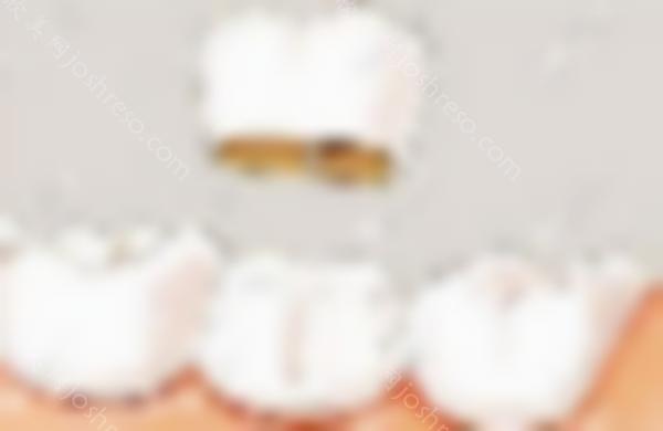 活髓牙已经在牙冠里20年了。它会在牙冠里坏吗？