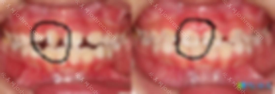 微管矫正牙齿的新技术对单颗牙齿畸形的矫正效果杠杆滴