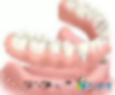 种植牙全口覆盖义齿修复的优缺点是什么？