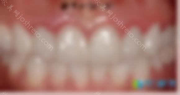 正畸安氏分类诊断标准与牙骨一类二类三类的区别