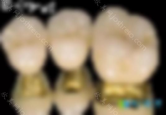 金属牙冠、烤瓷牙冠和全瓷牙冠哪个更适合牙齿缺损修复？
