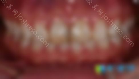 如何美白氟斑牙？丽江锦美口腔提供治疗方法和价格表
