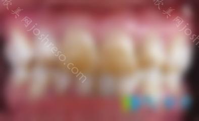 如何美白氟斑牙？丽江锦美口腔提供治疗方法和价格表