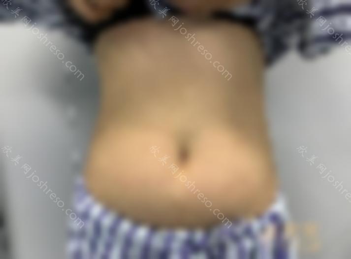 天津华美吸脂效果如何？专家详情+2024人气价目表~