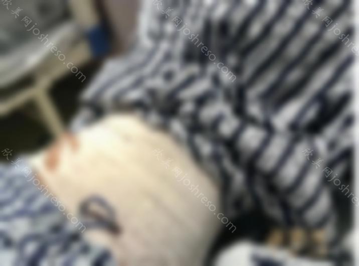 天津华美吸脂效果如何？专家详情+2024人气价目表~