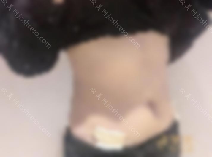 天津华美吸脂效果如何？专家详情+2024人气价目表~