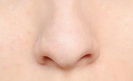 鼻子挺和不挺的区别图片？做隆鼻手术的时候整个过程分享