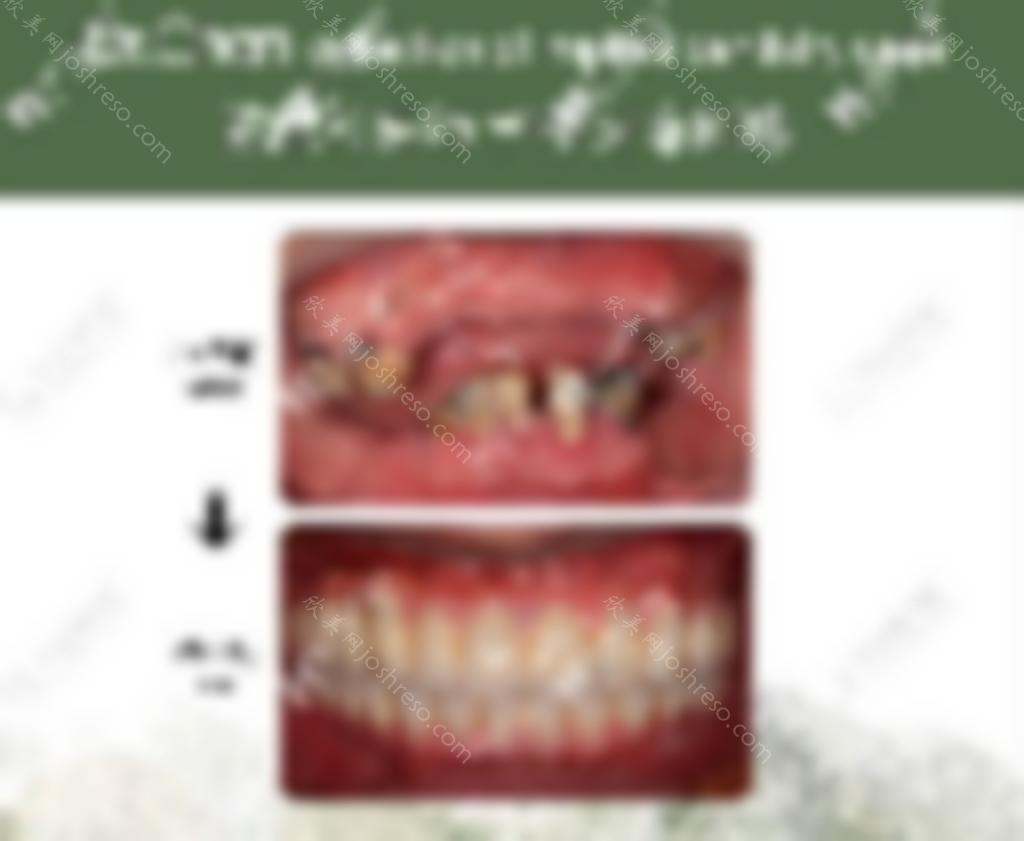 瞅这5.韩国在福州牙科收费表中dentium种植牙的价格不到5k