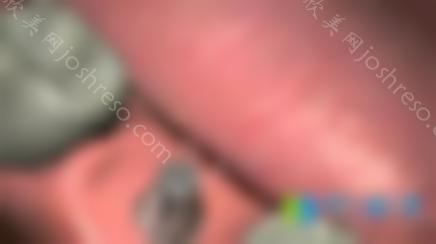 必看！种植牙愈合帽与愈合基台、愈合基台和修复基台的区别