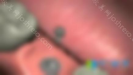 必看！种植牙愈合帽与愈合基台、愈合基台和修复基台的区别