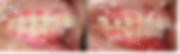 哈哈，终于明白了为什么隐适美更擅长磨牙后推的案例