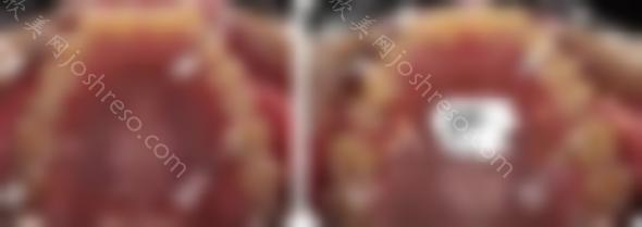 哈哈，终于明白了为什么隐适美更擅长磨牙后推的案例