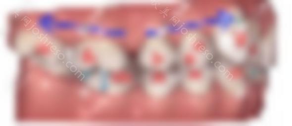 哈哈，终于明白了为什么隐适美更擅长磨牙后推的案例