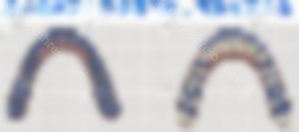 哈哈，终于明白了为什么隐适美更擅长磨牙后推的案例