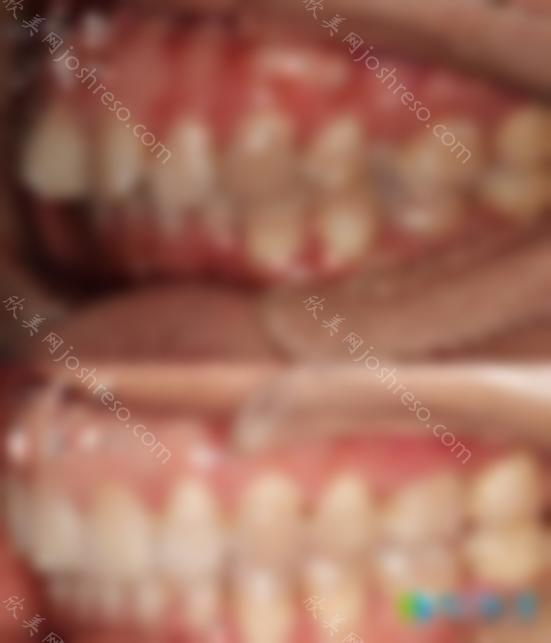 西宁新桥口腔口腔福利项目启动 特殊贡献者可享受免费种植牙