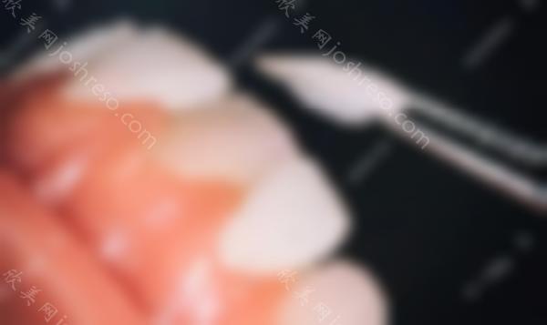 氟斑牙做全牙贴面要多少钱，尤其是超薄瓷贴面的价格