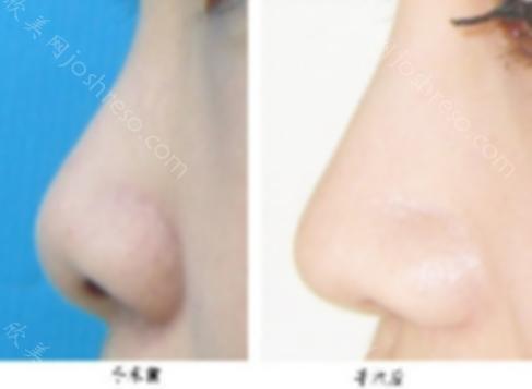 上海鼻尖整形多少钱？