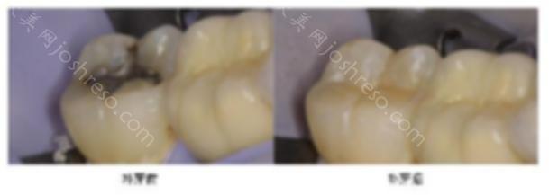 上海口腔医院牙齿有洞补牙多少钱