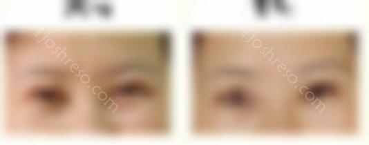 透明质酸如何去除鱼尾纹？