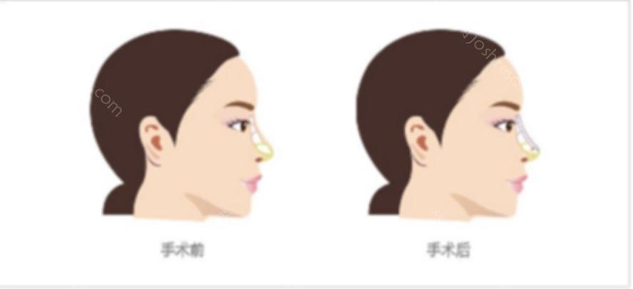 假体隆鼻有哪些优点？