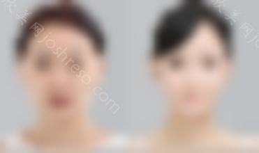南京安安医疗美容医院下颌角整形有什么优势？