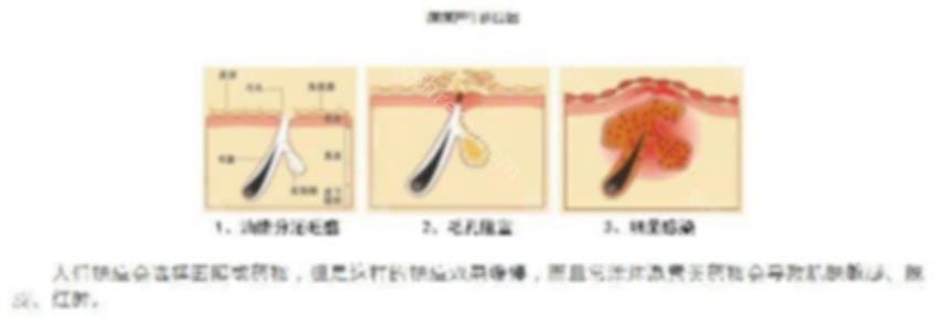 痘痘反复长 用LED红蓝光有效吗？