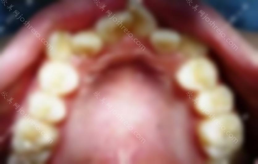 不用担心孩子换牙期牙不齐。西诺口腔MRC早期矫正案例了解下