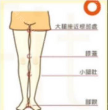 腿部抽脂瘦腿效果如何？