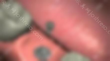 种牙要多久可以种好?这有种牙的流程,需要去几次确定不看嘛