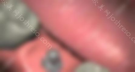 种牙要多久可以种好?这有种牙的流程,需要去几次确定不看嘛