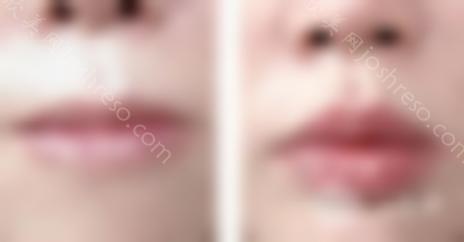 丰唇后透明质酸能见效多久？
