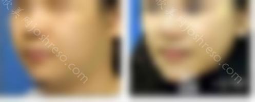 面部抽脂效果图