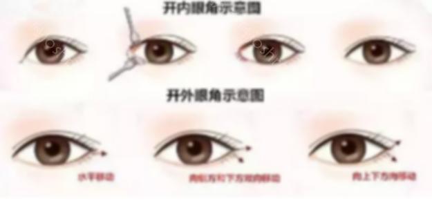上海开眼角的价格是多少？