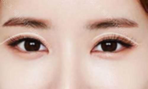 韩式三点双眼皮手术多少钱？