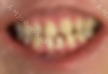 树脂牙贴面想取下来，卸下后牙齿还能正常吗？