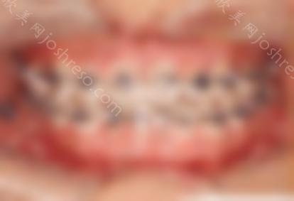 中线不均匀导致面部弯曲，到东莞同步牙科矫正恢复正常