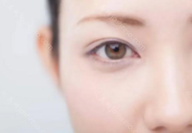 如何在去除眼袋手术后快速消肿 选择不当来破坏眼睛