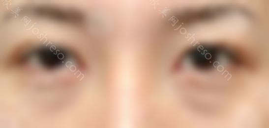 北京八大处双眼皮修复专家名单：于晓波、王太玲|双眼皮整形价格表