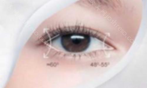 双眼皮有哪些类型，哪种效果好？