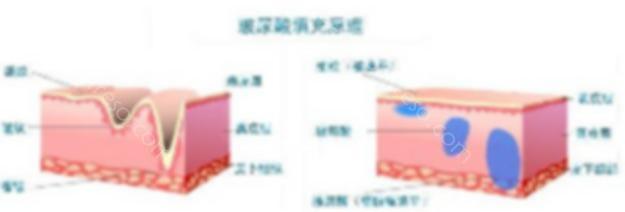 上海玻尿酸去鱼尾纹多少钱？