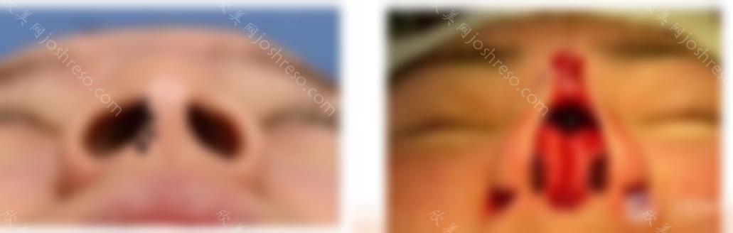 硅胶隆鼻有哪些注意事项？ 硅胶隆鼻手术图片