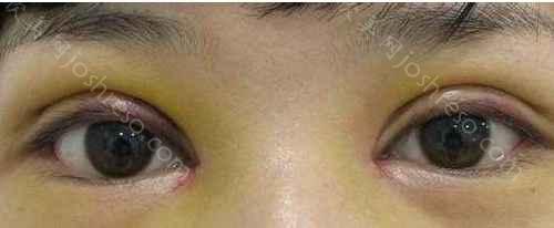 双眼皮水肿是什么原因